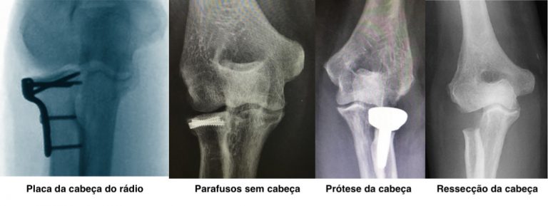 fratura-da-cabe-a-do-r-dio-dr-artur-utino-membro-do-grupo-de-ombro