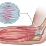 Epicondilite Medial